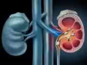 7 Effective Home Remedies for Kidney Stones. Causes of kidney Stone! Home Remedies for Kidney Stones