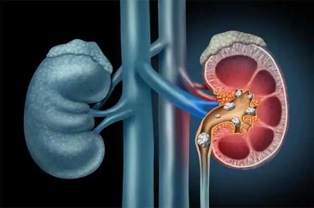 Home Remedies for Kidney Stones Home Remedies for Kidney Stones